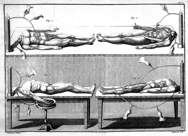 Galvanism, named after its inventor Luigi Galvani, used electrical currents to stimulate tissues in the body in the hope it could bring life to a dead body. Galvani’s nephew, Giovanni Aldini, used hanged criminals to perform public demonstrations in 1803, making the dead man’s eye twitch and his hands clench. Credit: Wellcome Collection.